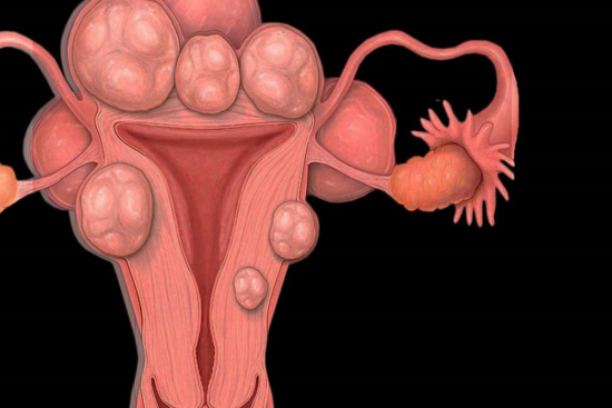 Removal of cervical polyps