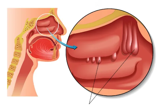 Causes of nasal polyps Causes of nasal polyps