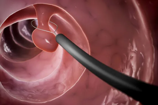Polypectomy: Treatment of nasal polyposis in Turkey Polypectomy: Treatment of nasal polyposis in Turkey