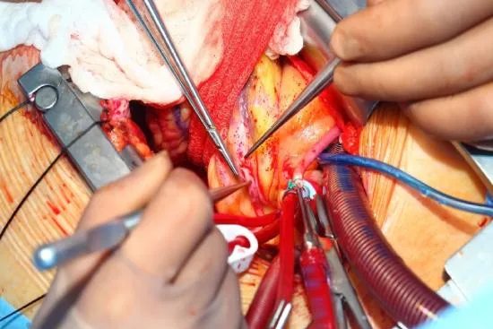 Recovery and follow-up after bypass surgery 2026