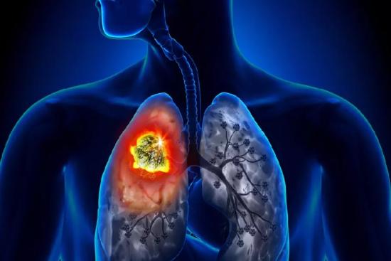 Tratamiento del cáncer de pulmón