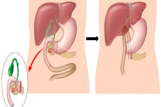 Whipple surgery