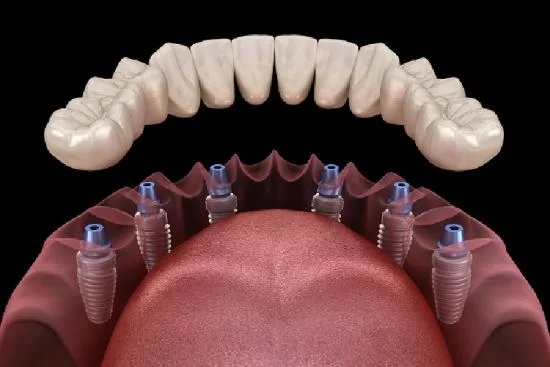 ¿Cómo mantener en buen estado las prótesis dentales? 2026 ¿Cómo mantener en buen estado las prótesis dentales? 2026