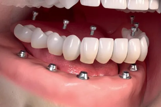 ¿Qué tipos de prótesis dentales existen? 2026 ¿Qué tipos de prótesis dentales existen? 2026
