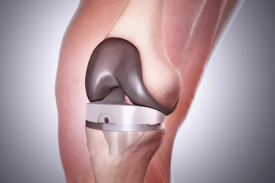 Precio de la prótesis de rodilla en Turquía Precio de la prótesis de rodilla en Turquía
