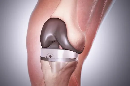 Knee replacement surgery in Turkey Knee replacement surgery in Turkey