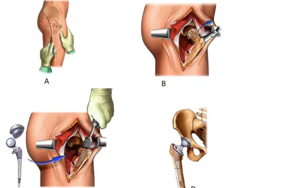 Which type of hip prosthesis is right for you? 2026 Which type of hip prosthesis is right for you? 2026