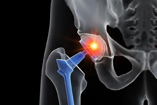 How long is the recovery after hip replacement surgery in Turkey? 2026 How long is the recovery after hip replacement surgery in Turkey? 2026
