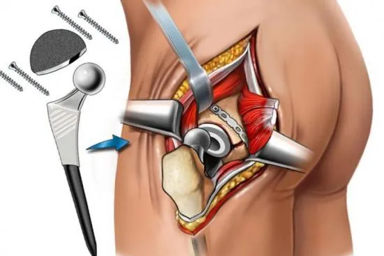 What surgical technique is used for hip replacement in Turkey? 2026 What surgical technique is used for hip replacement in Turkey? 2026