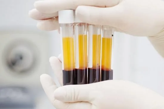 PRP treatment in Turkey