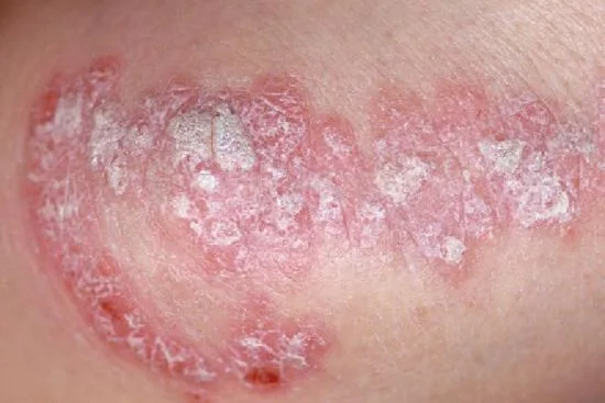 Traitement de psoriasis en Turquie Traitement de psoriasis en Turquie