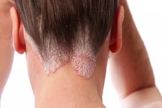 Traitement de psoriasis Traitement de psoriasis