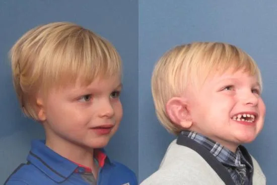 ear reconstruction cost ear reconstruction cost