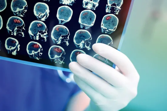 Stroke diagnosis and symptoms 2026