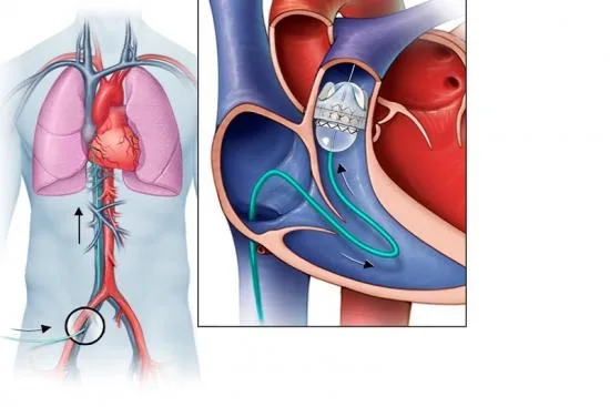 heart valves replacement in Turkey heart valves replacement in Turkey