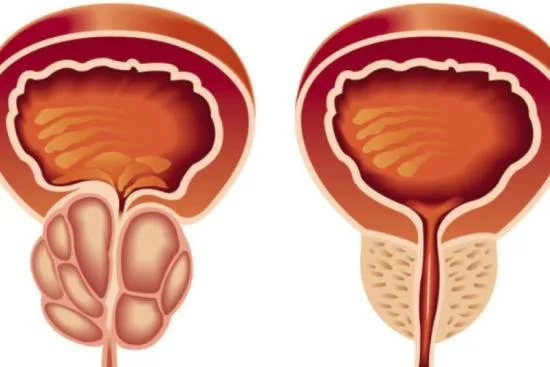 قبل و بعد علاج تضخم البروستاتا نتائج علاج تضخم البروستاتا