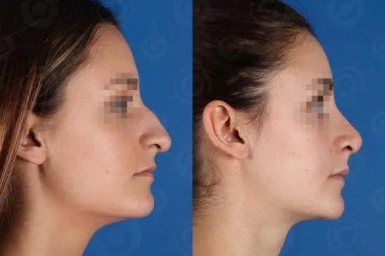 تجميل الانف تجميل الانف