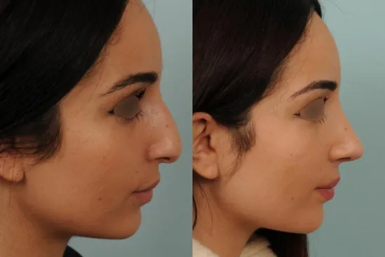 Rinoplastia funcional