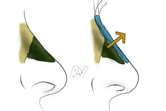 Types de la rhinoplastie Types de la rhinoplastie