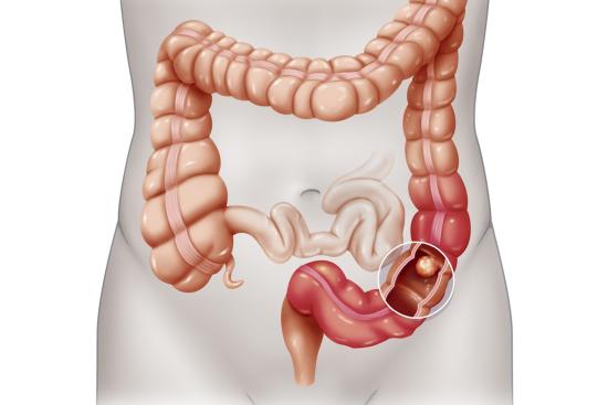Cirugía de cáncer de vías biliares