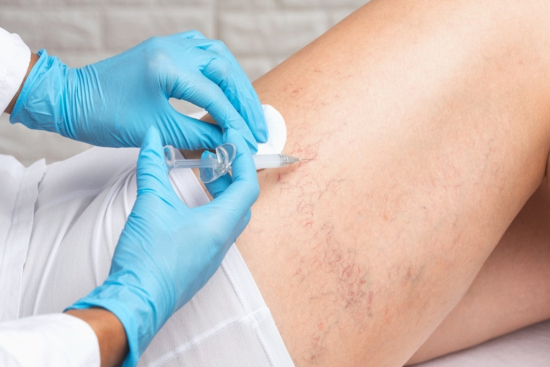 Escleroterapia