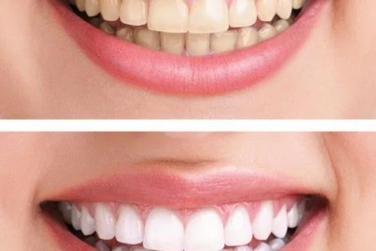 Tratamiento dental en Turquía