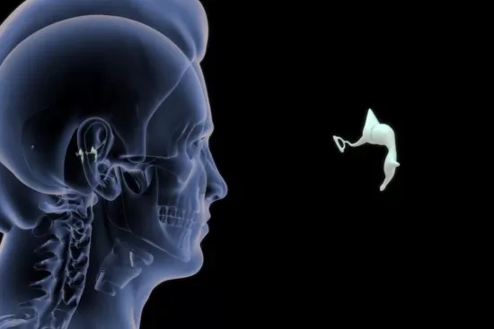 Diagnosis prior to stapedectomy 2026