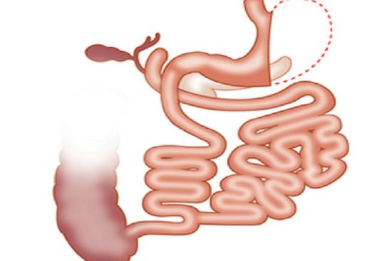 Derivación biliopancreática con cruce duodenal