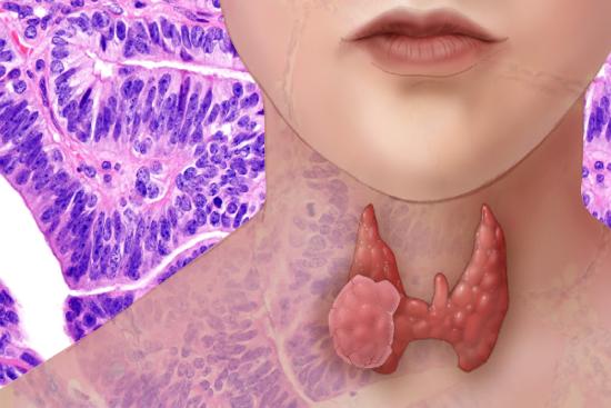 Thyroidectomy