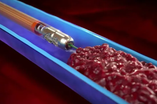 What is mechanical thrombectomy? 2026 What is mechanical thrombectomy? 2026