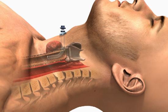 Tracheostomy