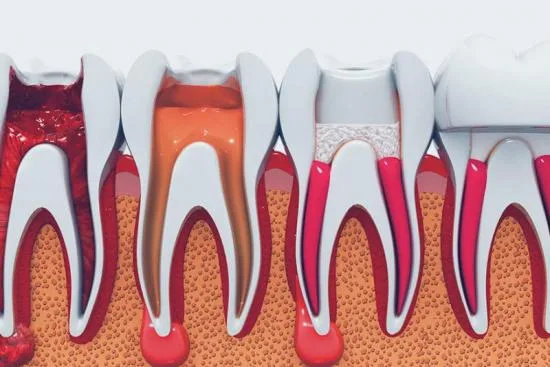 When is root canal treatment needed? 2026 When is root canal treatment needed? 2026