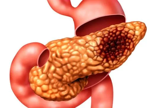 Pancreatic cancer