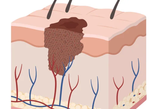 Skin cancer: What is it? 2026 Skin cancer: What is it? 2026