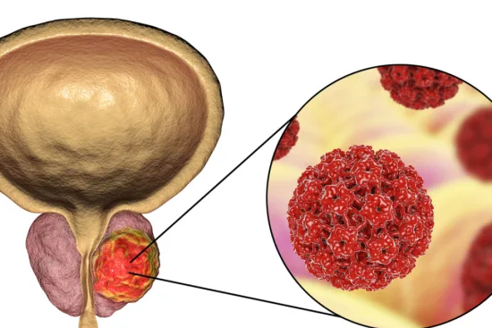 Cáncer de próstata: opciones de tratamiento en Turquía 2026