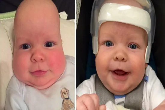 What is craniosynostosis? 2026