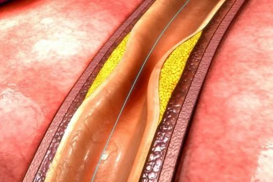 Arteriosclerosis obliterante: qué es realmente 2026