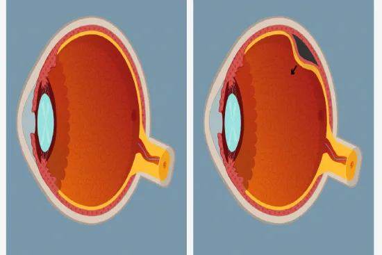 Retinal detachment surgery in Turkey