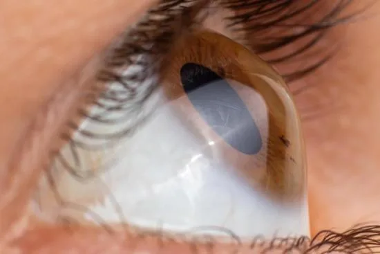 Keratoconus treatment in Turkey Keratoconus treatment in Turkey