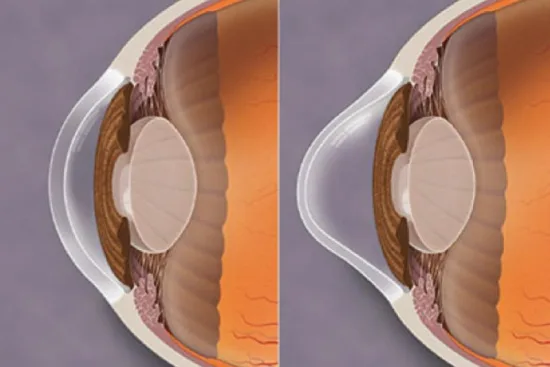 Keratoconus treatment in Turkey Keratoconus treatment in Turkey
