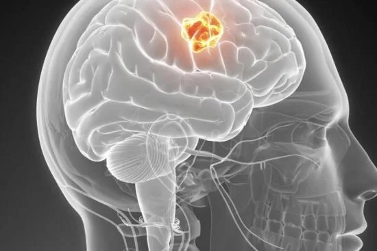 Brain surgery price in Turkey Brain surgery price in Turkey