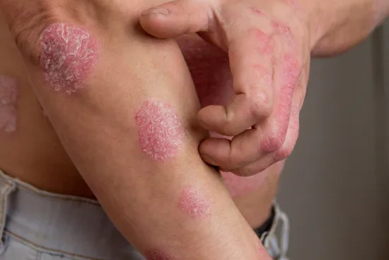 Skin disease