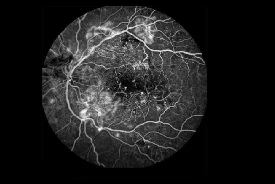 What is diabetic retinopathy and why does it progress silently? 2026 What is diabetic retinopathy and why does it progress silently? 2026