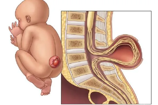 Traitement du Spina Bifida 