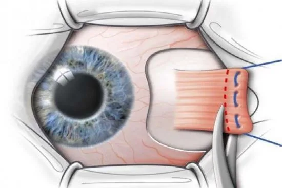 Causes of strabismus 2026 Causes of strabismus 2026