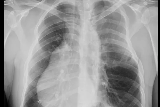 Diagnosis of Poland syndrome 2026 Diagnosis of Poland syndrome 2026