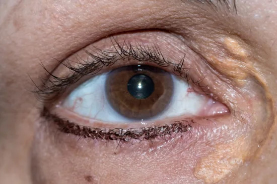 Xanthelasma: What is it? 2026 Xanthelasma: What is it? 2026