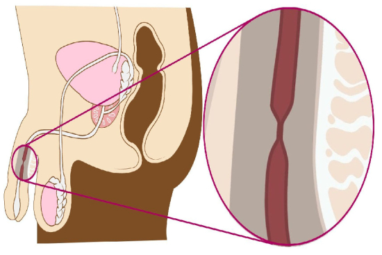 Urethral repair surgery