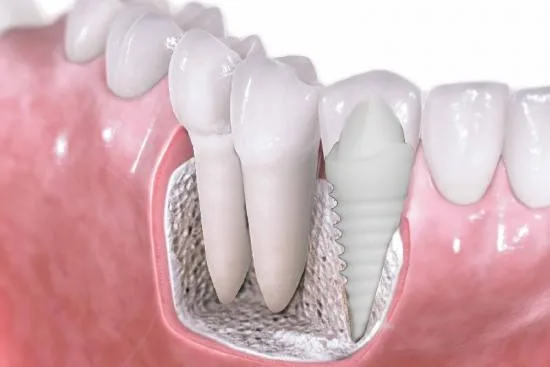 Zirconia veneers in Turkey Zirconia veneers in Turkey