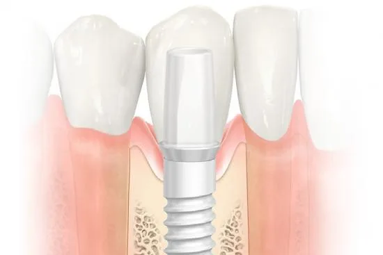 Zirconium veneers in Turkey Zirconium veneers in Turkey